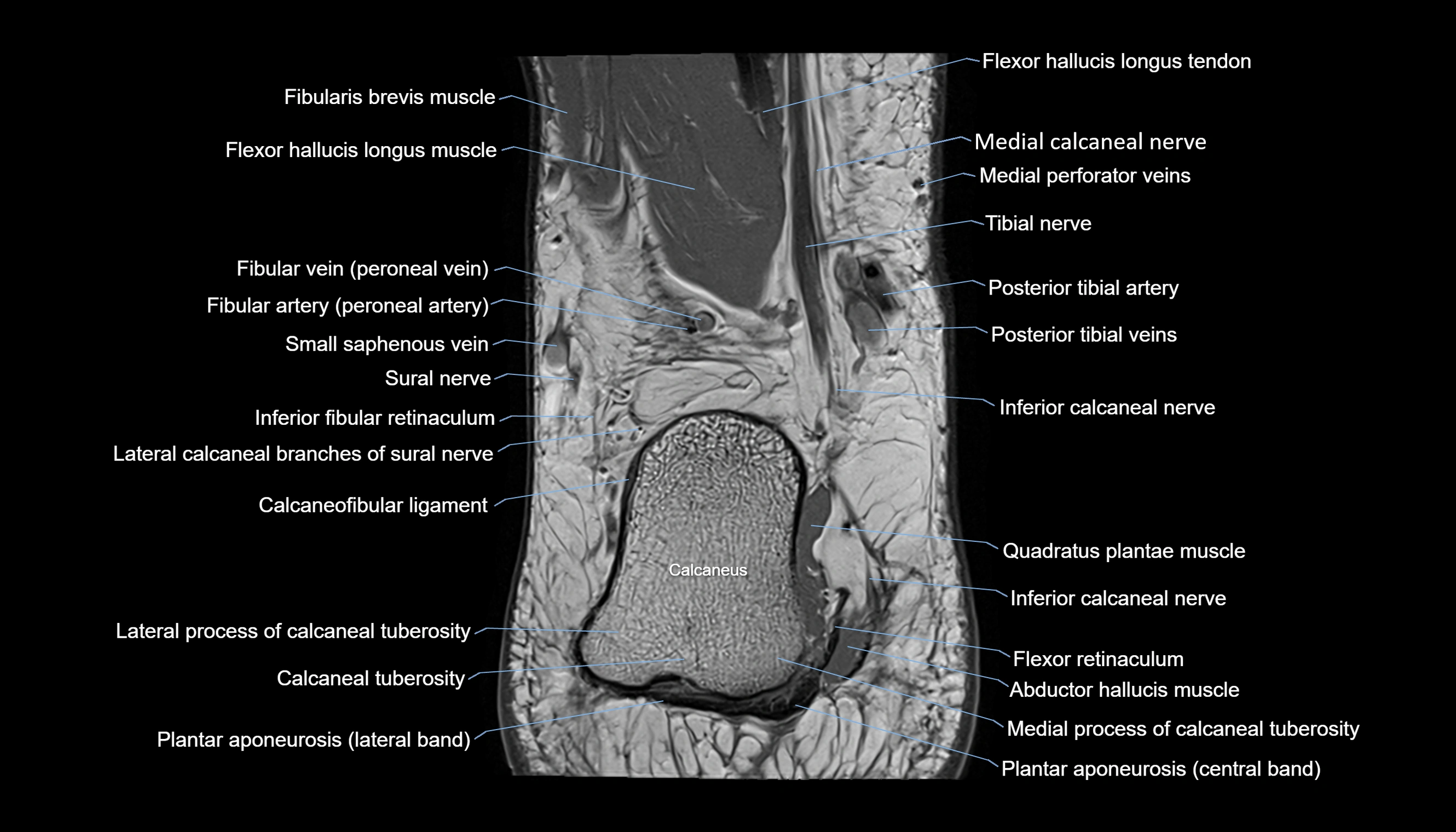 Ankle coronal anatomy 3T MRI images -img-11001-00023.webp